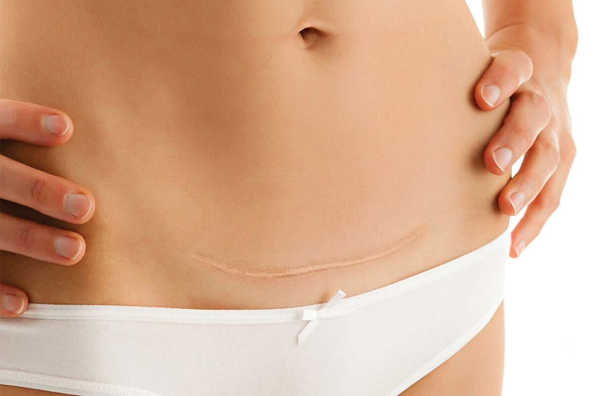 ¿Cuáles son los peligros de una abdominoplastia?